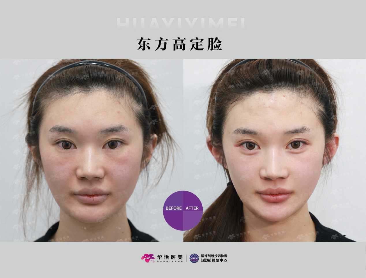 在威海打玻尿酸哪家医院好？华怡医美贾利霞院长：正规注射，安心变美