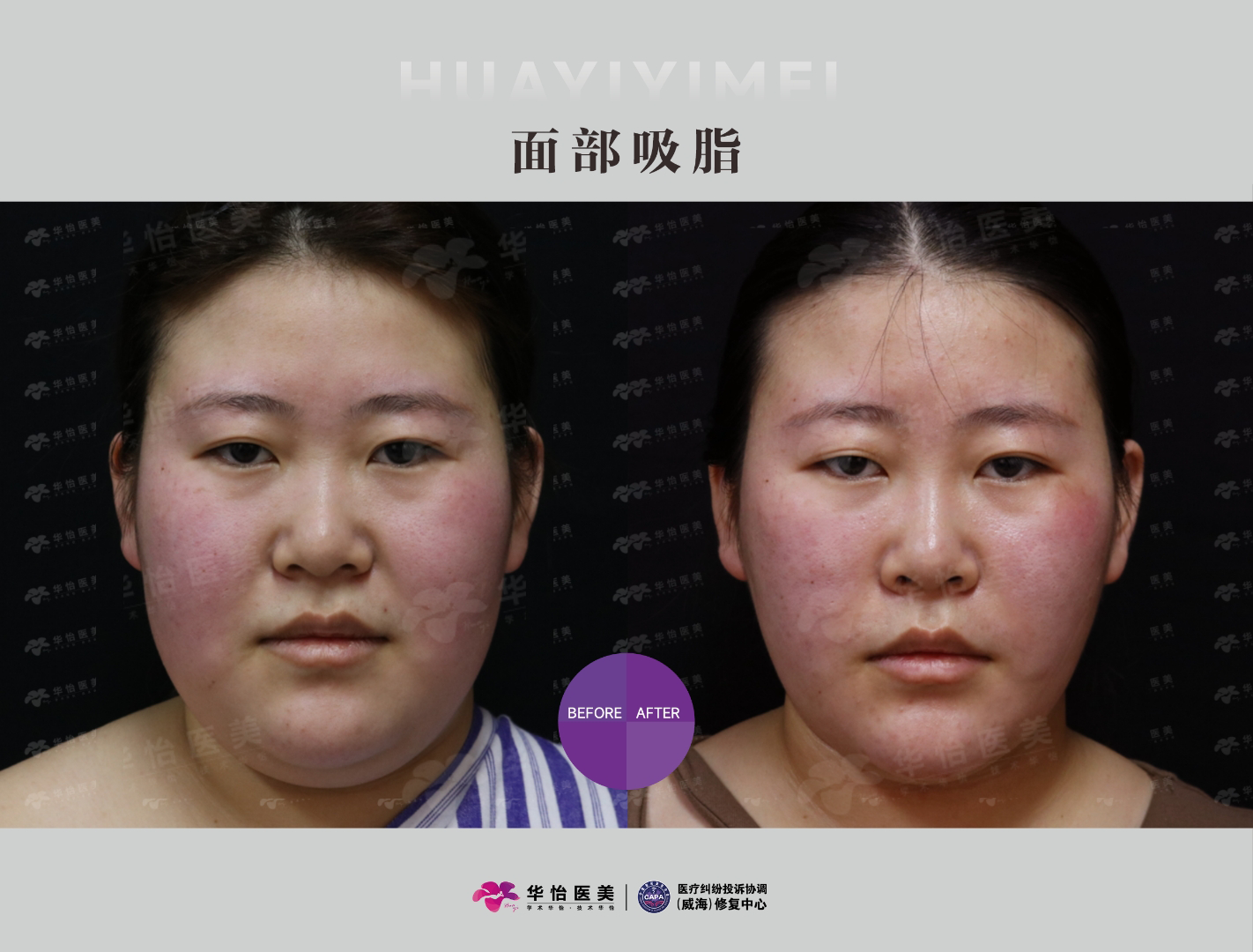 威海面部吸脂攻略｜华怡李耀辉主任：精细化轮廓塑形，打造自然精致小V脸